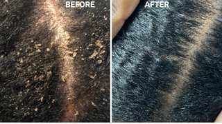 Scalp Eczema Oil | Intensive Ayurvedic Treatment - Dandruff, Psoriasis, Hair Growth, Fungus